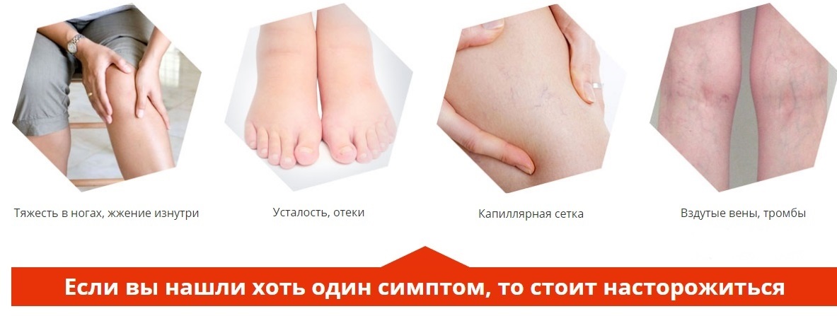 Симптомы варикозного расширения вен