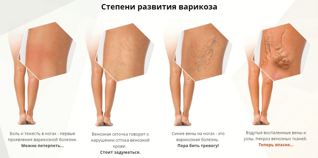 Стадии варикозной болезни