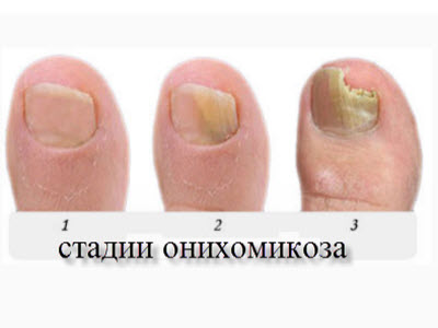 стадии грибка